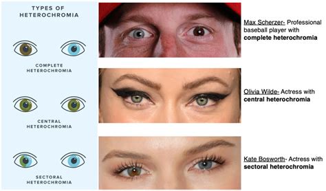 Talk:Heterochromia .